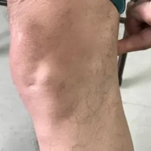 Elycura Microdarts Patch Joint Relief Hyaluronic + Curcumin